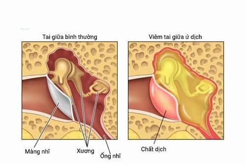 Externa otitis - Ảnh minh họa 3