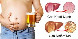 Fatty Liver - Ảnh minh họa 4