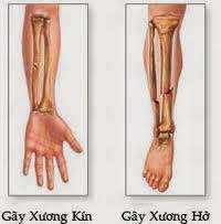 Foot fracture - Ảnh minh họa 1