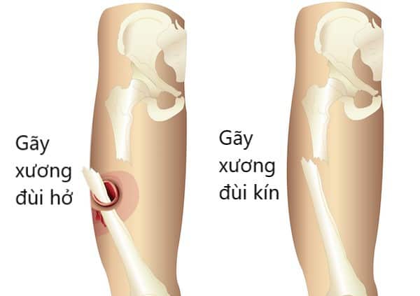 Foot fracture - Ảnh minh họa 3