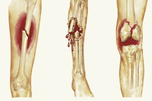 Foot fracture - Ảnh minh họa 4