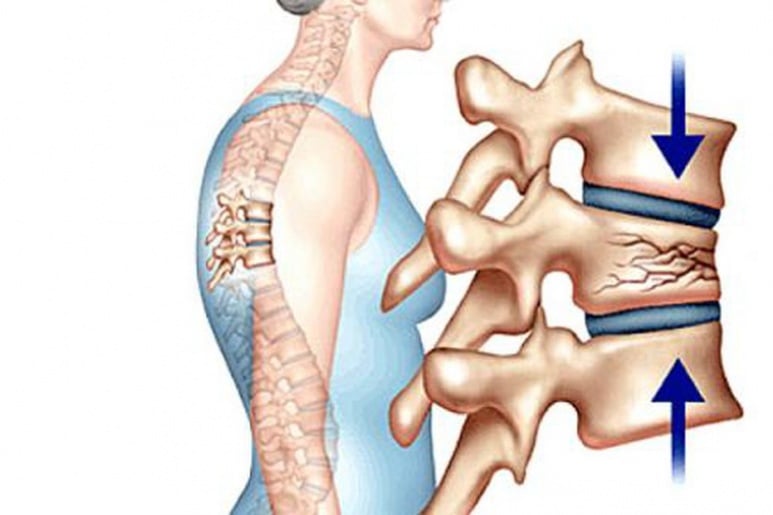 Bệnh Giòn xương: Nguyên nhân, biến chứng và cách điều trị