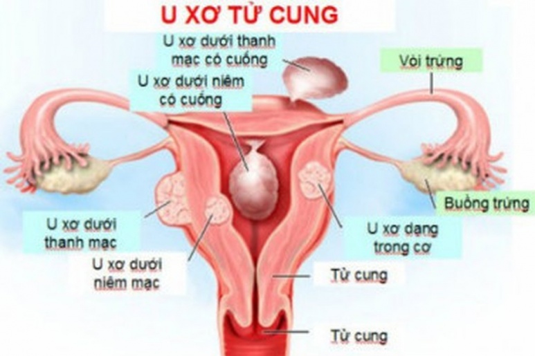 Fibromyoma fibroleiomyoma - Ảnh minh họa 1