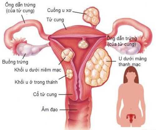 Fibromyoma fibroleiomyoma - Ảnh minh họa 3