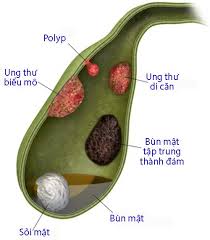 Gallbladder polyp - Ảnh minh họa 1