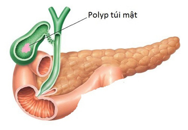 Gallbladder polyp - Ảnh minh họa 2