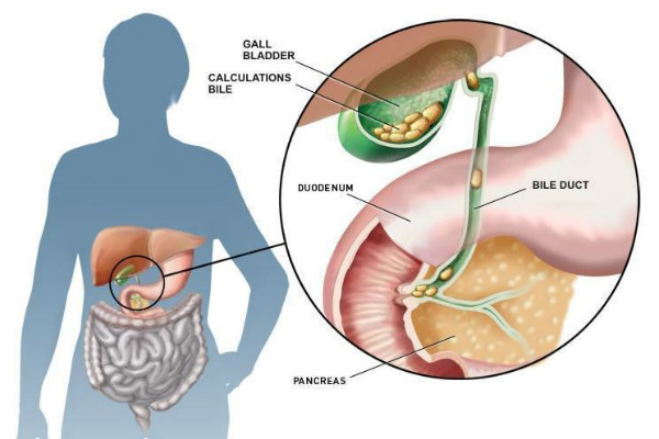 Gallbladder polyp - Ảnh minh họa 3