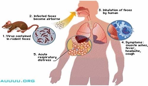 Febris haemorrhagia Hantaviruso - Ảnh minh họa 2