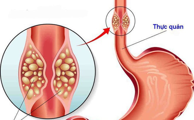 Esophageal cancer - Ảnh minh họa 2