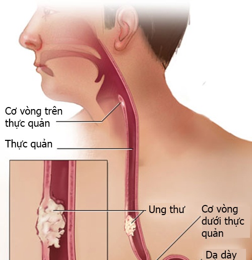 Esophageal cancer - Ảnh minh họa 3