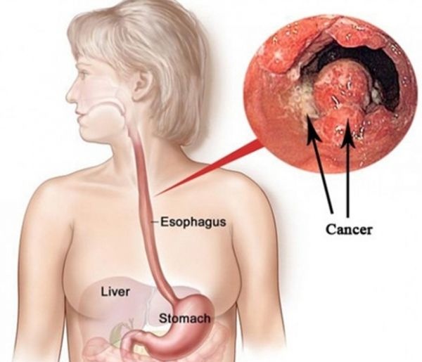 Esophageal cancer - Ảnh minh họa 5