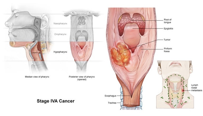 Esophageal cancer - Ảnh minh họa 4