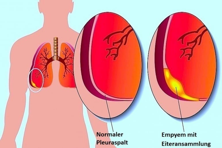 Empyema - Ảnh minh họa 1