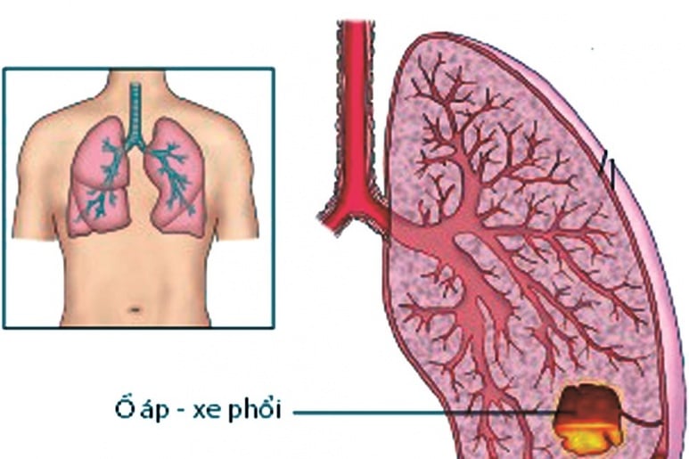 Empyema - Ảnh minh họa 2