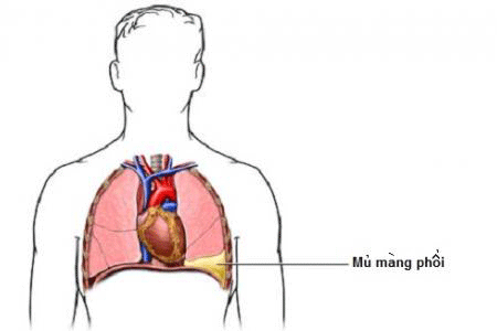 Empyema - Ảnh minh họa 3