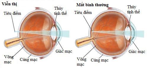 Farsightedness - Ảnh minh họa 2