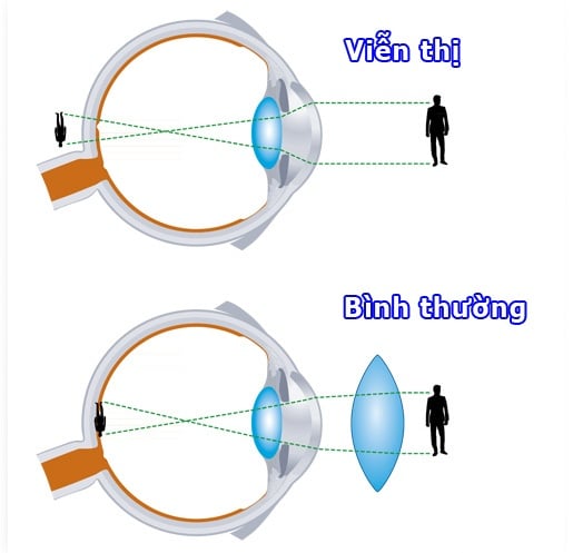 Farsightedness - Ảnh minh họa 3