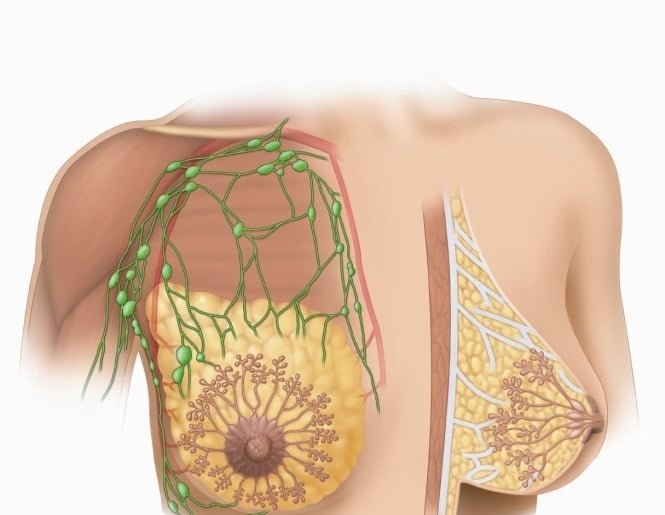 Fibrocystic - Ảnh minh họa 4