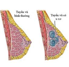 Fibrocystic - Ảnh minh họa 2