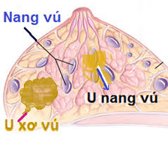 Fibrocystic - Ảnh minh họa 3