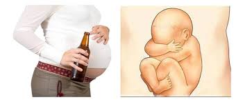 Fetal Alcohol Syndrome - Ảnh minh họa 2