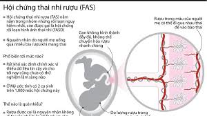 Fetal Alcohol Syndrome - Ảnh minh họa 4