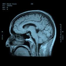 Fibromuscular Dysplasia - Ảnh minh họa 1