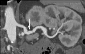 Fibromuscular Dysplasia - Ảnh minh họa 2