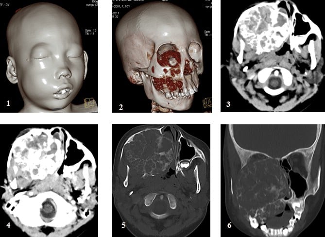 Fibromuscular Dysplasia - Ảnh minh họa 3