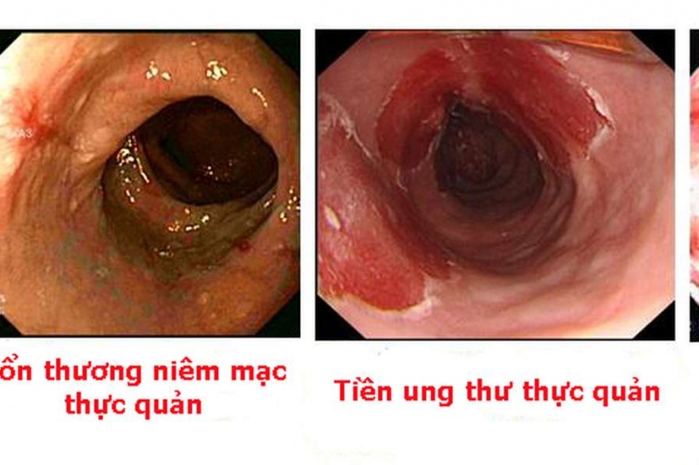 Esophageal Webs - Ảnh minh họa 2