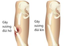 Femoral Fracture - Ảnh minh họa 2