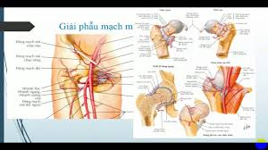 Femoral Fracture - Ảnh minh họa 3