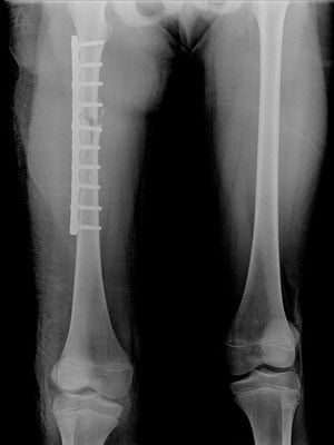 Femoral Fracture - Ảnh minh họa 4