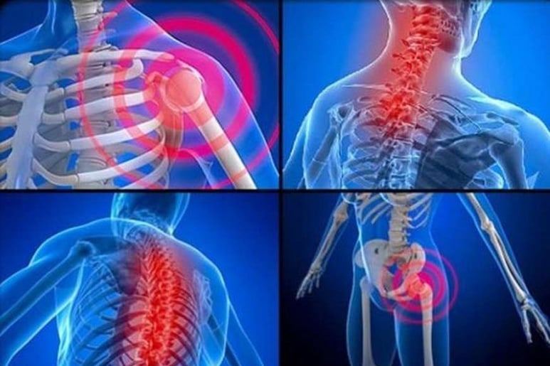 Fibromyalgia Syndrome - Ảnh minh họa 1