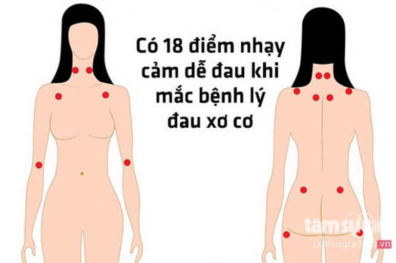 Fibromyalgia Syndrome - Ảnh minh họa 2