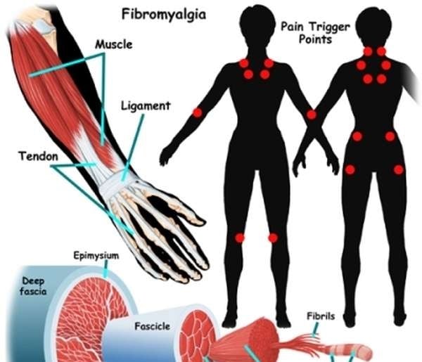 Fibromyalgia Syndrome - Ảnh minh họa 3