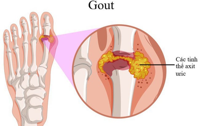 Gút - Ảnh minh họa 2