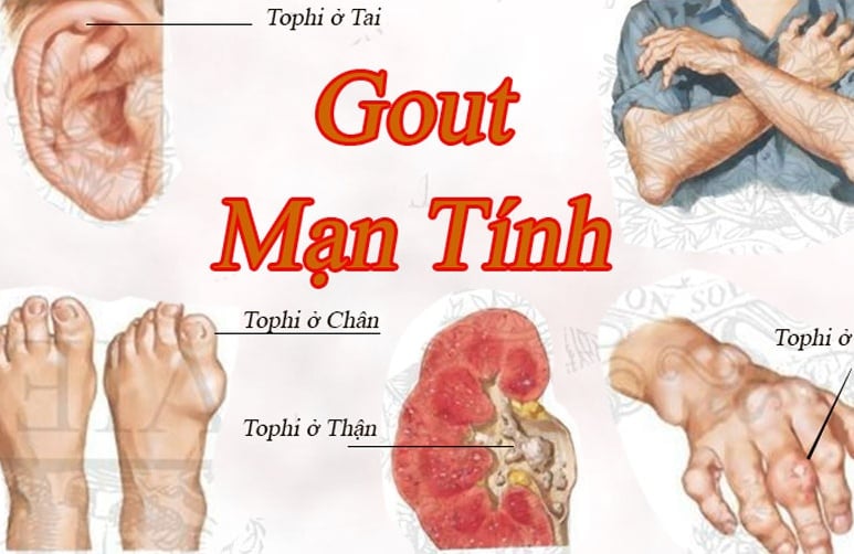 Gút - Ảnh minh họa 4