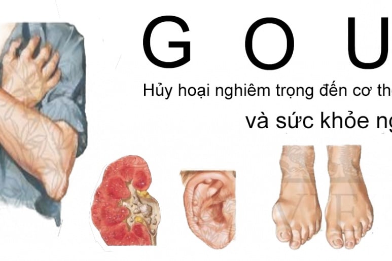 Gút - Ảnh minh họa 5