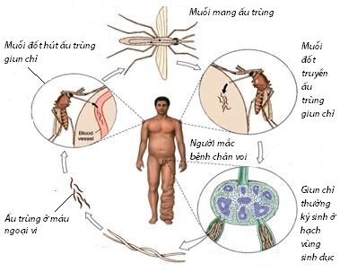 Giun chỉ bạch huyết - Ảnh minh họa 1