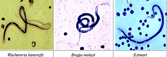 Giun chỉ bạch huyết - Ảnh minh họa 3