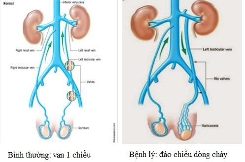 Giãn tĩnh mạch tinh - Ảnh minh họa 1