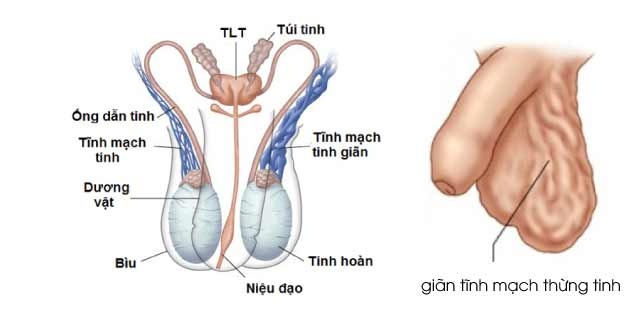 Giãn tĩnh mạch tinh - Ảnh minh họa 2