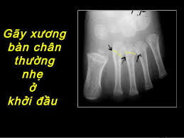 Gãy xương bàn chân - Ảnh minh họa 3