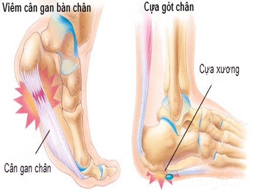 Gai xương gót chân - Ảnh minh họa 2