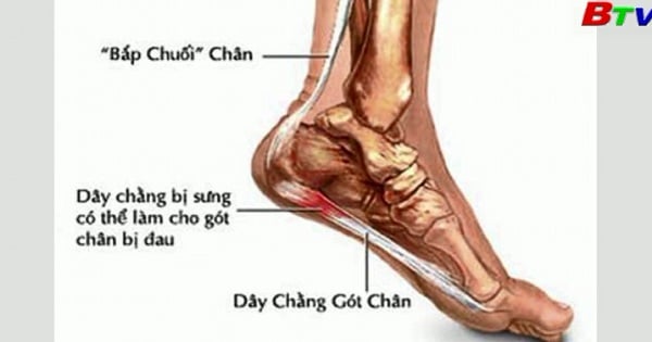 Gai xương gót chân - Ảnh minh họa 4