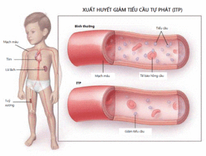 Giảm tiểu cầu - Ảnh minh họa 2