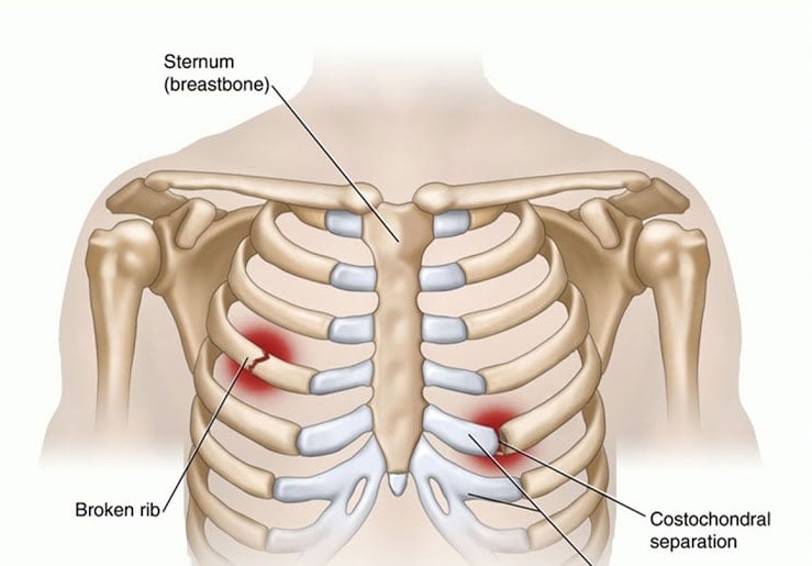 Gãy xương sườn - Ảnh minh họa 1