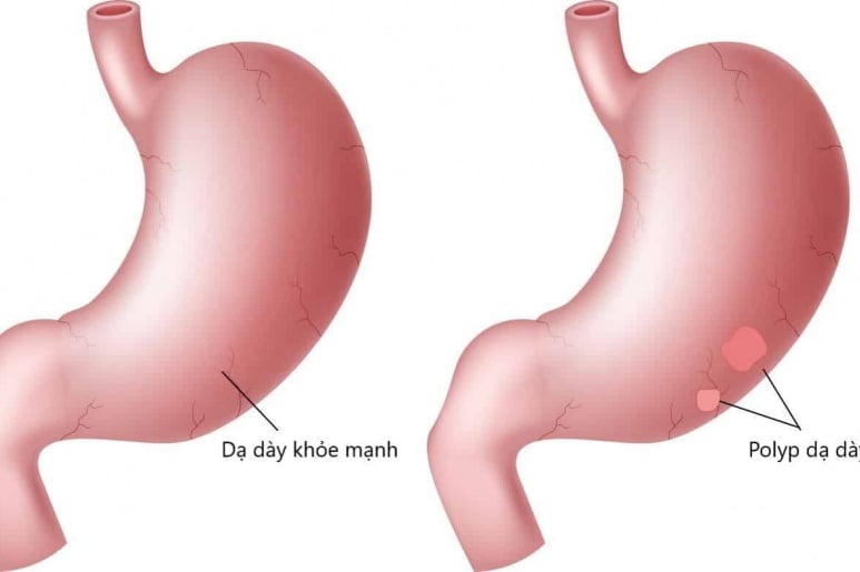 Gastric polyp - Ảnh minh họa 1