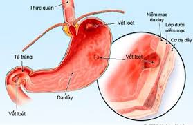 Gastric polyp - Ảnh minh họa 2